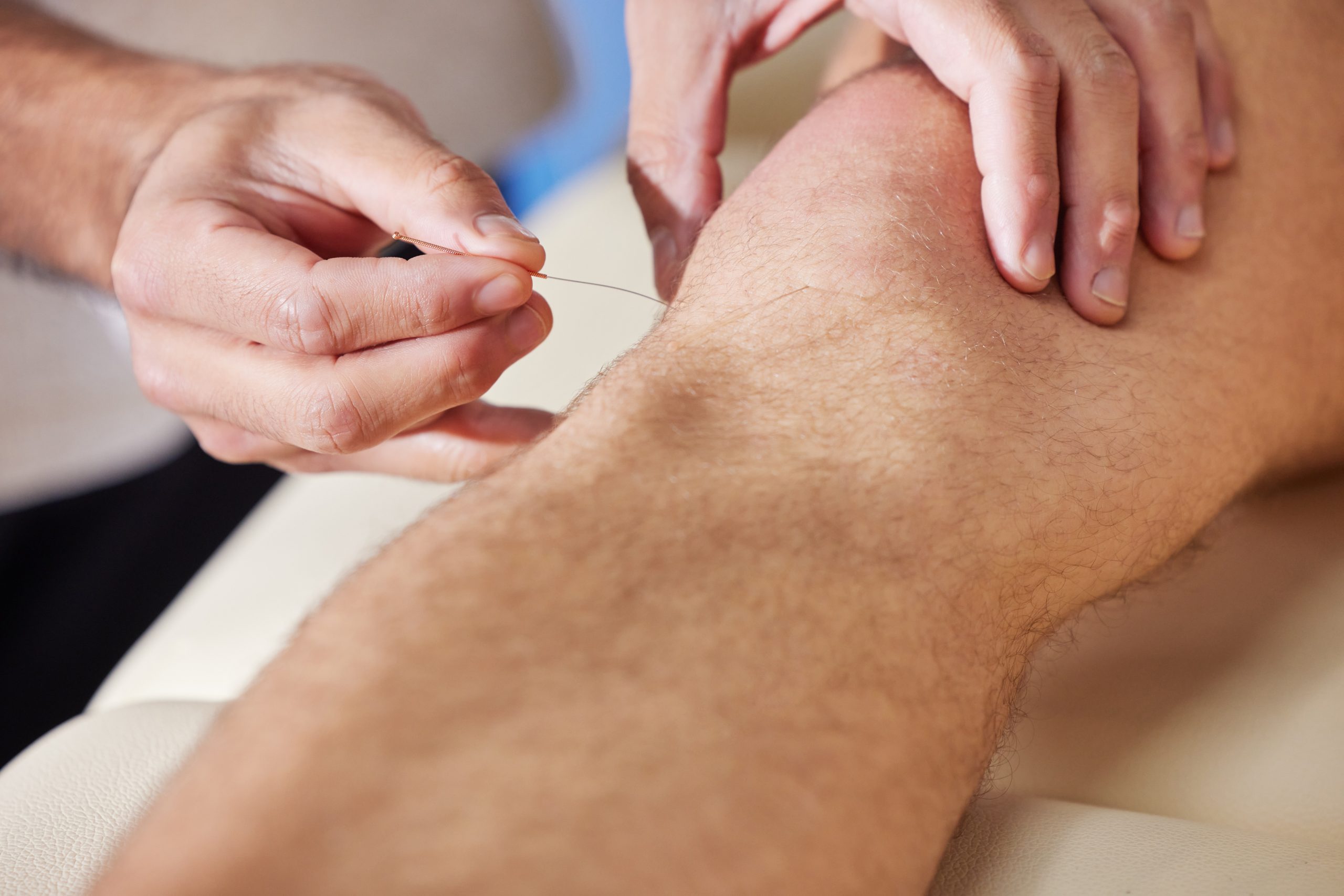 Shot of a acupuncturist treating a client.